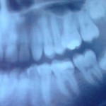 photo of teeth x-ray