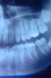 photo of teeth x-ray