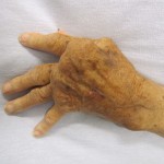 Photo of a hand with rheumatoid arthritis