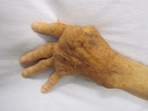 Photo of a hand with rheumatoid arthritis