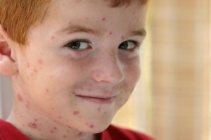 Photo of a boy with chickenpox