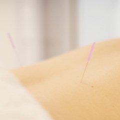 Photo of acupuncture
