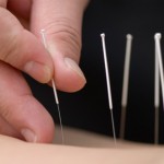 Close up photo of acupuncture needles in skin