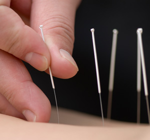 Close up photo of acupuncture needles in skin