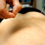 Photo of a patient receiving acupuncture