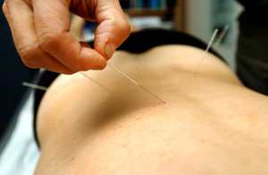Photo of a patient receiving acupuncture