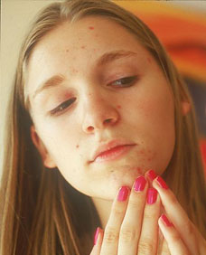 Photo of a young women with acne