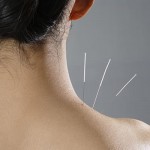 Photo of acupuncture needles in a woman's shoulder