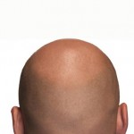 Photo of a bald head taken from the back