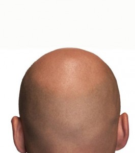Photo of a bald head taken from the back