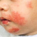 Poto of a child with eczema on the face