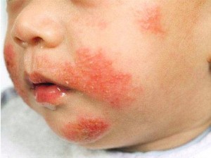 Poto of a child with eczema on the face