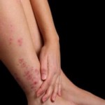 Photo of an itchy rash on a woman's legs