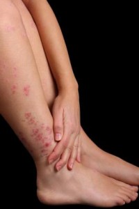 Photo of an itchy rash on a woman's legs