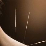 Photo of acupuncture needles in a woman's neck