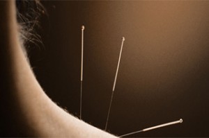 Photo of acupuncture needles in a woman's neck