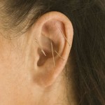 Photo of ear acupuncture for weight loss