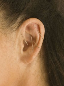 Photo of ear acupuncture for weight loss