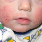 Photo of a child with atopic dermatitis