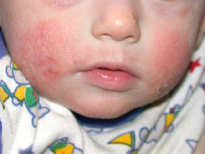 Photo of a child with atopic dermatitis