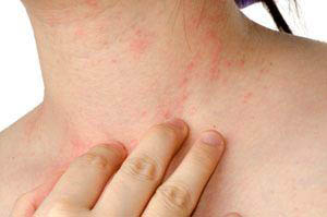 Photo of a woman's neck with hives