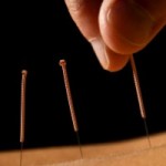 Close up photo of acupuncture on the back
