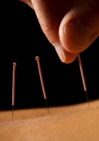 Close up photo of acupuncture on the back