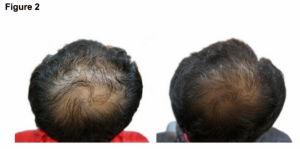 Hair regrowth with punpkin seed oil