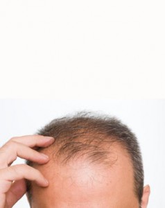 photo of a man with male pattern baldness