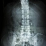 xray of a spine