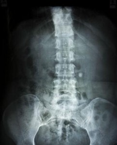 xray of a spine